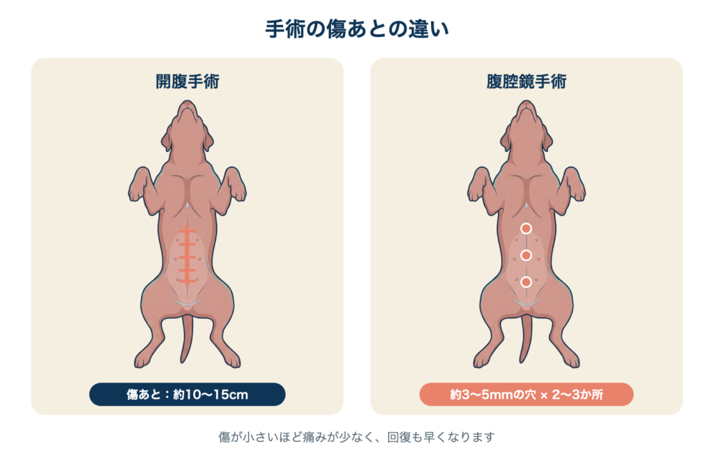 開腹手術と腹腔鏡手術の傷あとの違い。開腹手術は大きな切開、腹腔鏡手術は数ミリの穴が数か所ですむ。