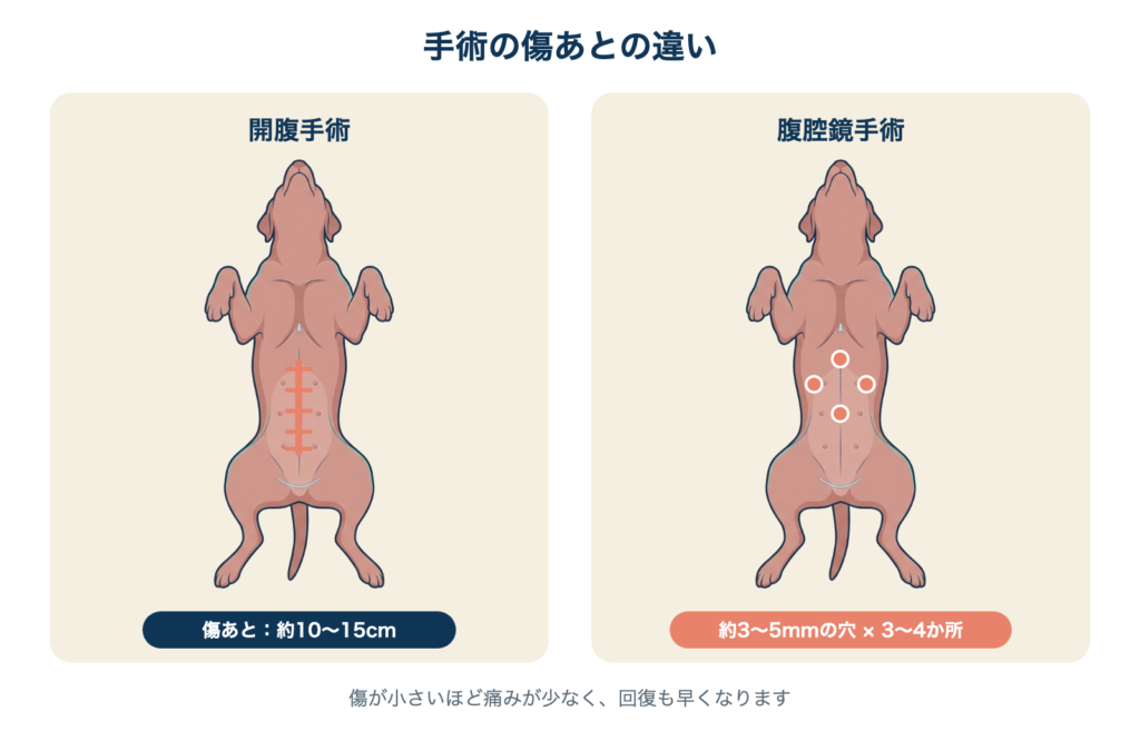 開腹手術と腹腔鏡手術の傷あとの違い。開腹手術は約10〜15cmの切開、腹腔鏡手術は約3〜5mmの穴が3〜4か所。