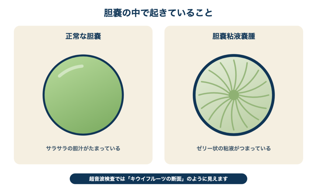 正常な胆嚢と胆嚢粘液嚢腫の比較。正常はサラサラの胆汁、粘液嚢腫はゼリー状の粘液がつまり、超音波ではキウイフルーツの断面のように見える。