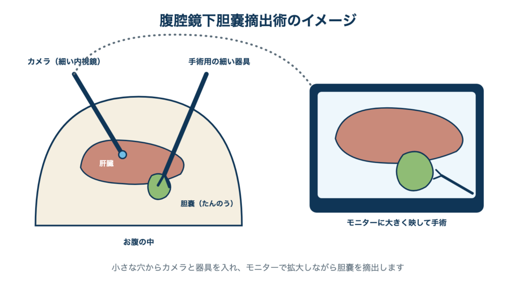 腹腔鏡下胆嚢摘出術のイメージ。小さな穴からカメラと器具を入れ、モニターに拡大表示しながら胆嚢を摘出する。