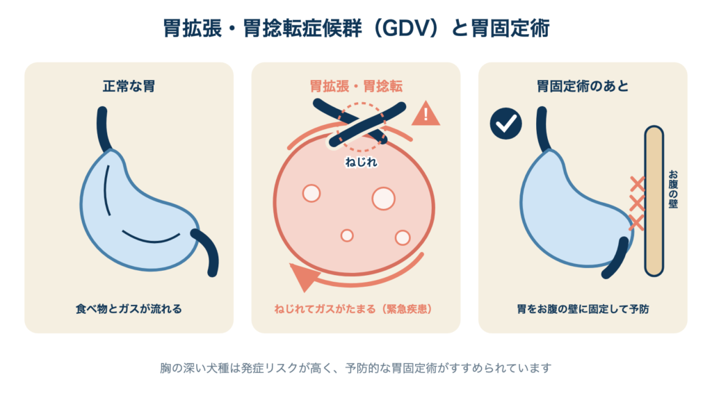 正常な胃、胃拡張・胃捻転でねじれた胃、胃固定術でお腹の壁に固定した胃の3コマ比較図